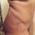 6 week scar - left side