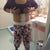 One day post op still not standing straight