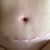close up of scar - after shower and new skin silicone scar creme applied.