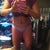 Post op day 1 without binder