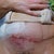 5 weeks PO, infection in centre (where it's red), feels hard and warm to touch. gauze on my right side is from a stitch that came up.