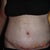 8 days post op very very swollen