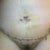 Front view 4 days post op.  See the swelling of the abdomen