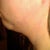 1 Day Post - Left Side