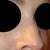 You can really see the split between my nasal bones here.