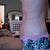 3 weeks po. Still a little swollen around the top of my underwear line