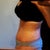 23 days post op. Still swollen but going down after losing 5 pounds.
