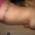 left side of my gnarly infectious looking scar.