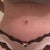 10 days post op..closer look. Swollen still but no hang!! Yeah