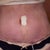 See my old bb hole above the incision. I did not have enough skin to remove it so it just gets sown shut.