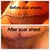 Scar Away silicone scar sheets