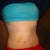 After!!!!  6 Days PO.  The redness is from my binder.  Belly button is my original.  I was set on keeping it and my surgeon was awesome in helping me do so!