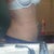 post op day 5 abd/hip