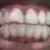 Week 1 (with attachments and aligners)