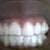 Week 3 (with attachments and aligners)