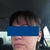 Seven days after laser. You can still see how pink the subcision areas are. Subcision was two weeks ago. I have makeup on. This is my better side -- the left. Very happy with result on this side.