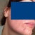 Seven days after laser. You can still see how pink the subcision areas are. Subcision was two weeks ago. No makeup. Right side and my bad side. Looks better. That spot really plumped up. (The one below the corner of my mouth.)