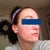 Seven days after laser. You can still see how pink the subcision areas are. Subcision was two weeks ago. No makeup. Bad side. Think cheeks look great.
