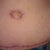 Tummy tuck 11-19-11