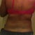 Back 1 day after surgery