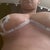 5 days post op