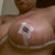 5 days post op