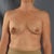 After 1st reconstructive fat surgery