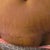 Used the Scar FX strips on this area for 4 days, and see vast imporvment already the area above my swollen Vj is looking so thin and fine already