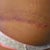 This is the side where I had the popped stitch I had a scar cream rejuvsil it is one of those silicone creams I have been using on the long part of each side since I cant get the strips to lay  there properly