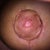 Nipple healing up good! 2 weeks post op!