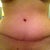 21 days post op with seroma