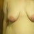 Breasts before