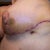 Left side view 1 week post op ... not real pretty looking