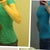 Before and after in same shirt.. A push up bra will help my profile. This is day 5 since explant.