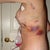 Day 3 post op side view