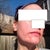 One month later. Outside. No makeup. I do have a moisturizer with sunscreen.