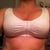11 days post op