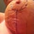 Left Incision
(Sorry for the gross shot)