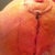 Right incision 11 days post op