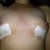 Front view 7 days - different angle to show the caving of the right nipple