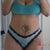 pre-op 5 days the time and date at the bottom of this pic is wrong havent set the correct time and date on my camera shoukd be 03/31/12