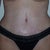 13 days post-op