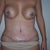 1 week post-op, front view