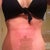 14 days post op. A lot of my swelling has gone down, but still quite a bit just above my incision. I have to keep tape on for first full 6 weeks. I'll try and snap a pic and my next post op when they change out tape again next week. The red mark above the tape is from my compression girdle.