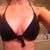 This is also 14 days post op. The girls are slowing making their "descent". I think the massaging I just started on Monday has helped. I haven't been icing much, but I got to admit I did this morning and it felt great.