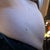 Before, side view.  You can see where the hernia was.