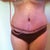 1 week p.o.  Swelling is starting