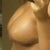 3 weeks Post Op