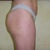 Right side 5 months post op