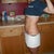 1 week post op